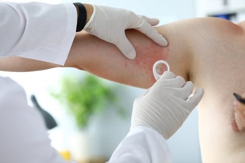 consulta medica por herpes en la piel
