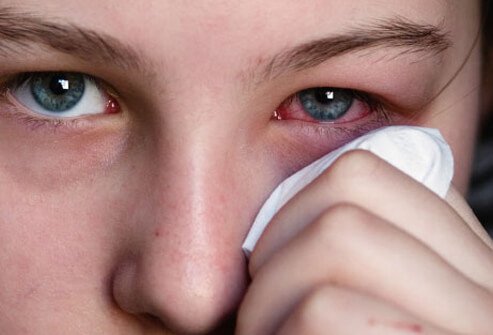 duración del herpes ocular