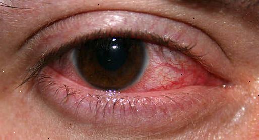 enrojecimiento del ojo por herpes