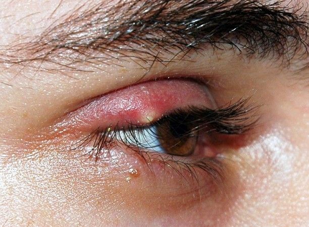 foto de herpes en el ojo