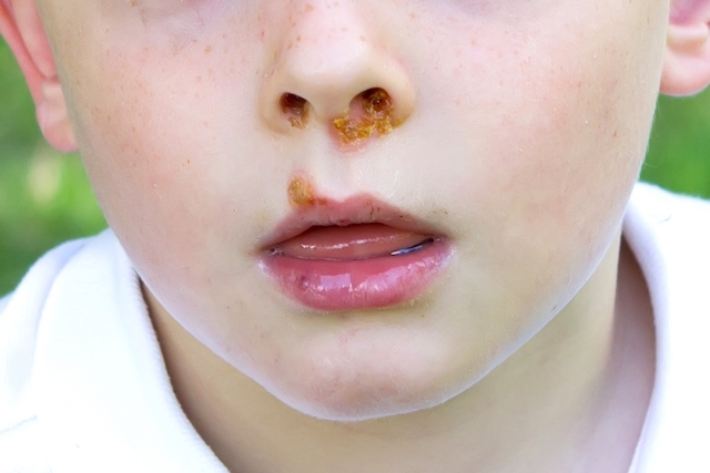 foto de herpes en la nariz