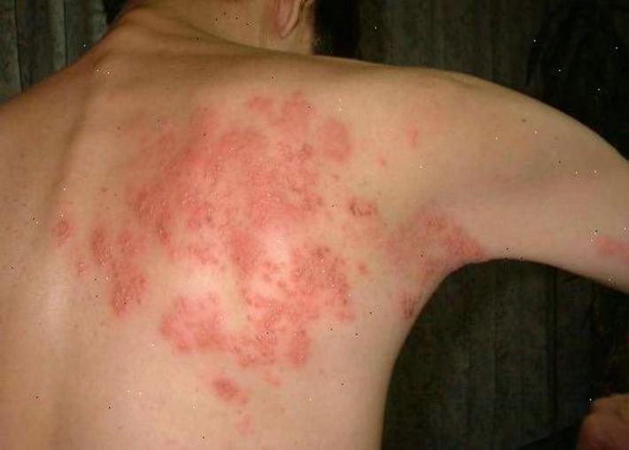 herpes de espalda simple 