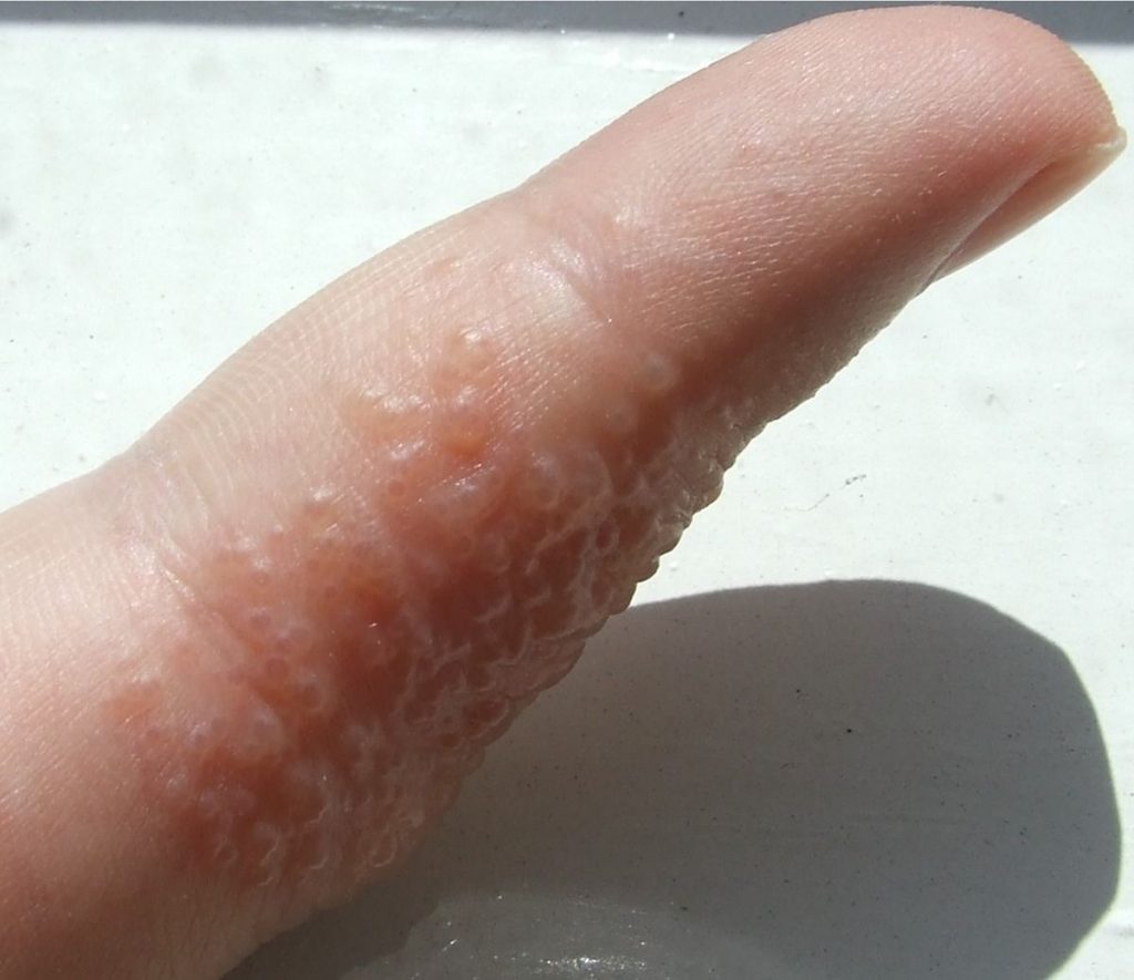 herpes en el dedo