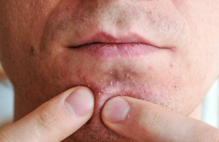 brote de herpes en la barbilla