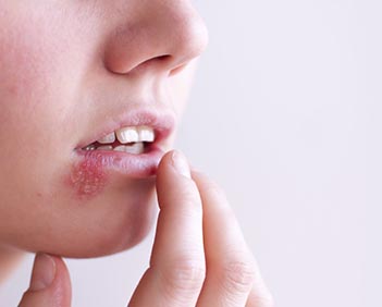 herpes en la boca sintomas