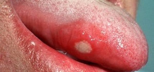 brote de herpes en la lengua