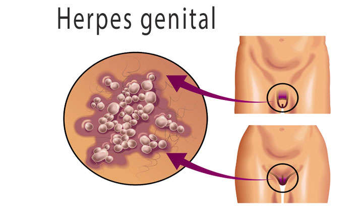 herpes genital sintomas