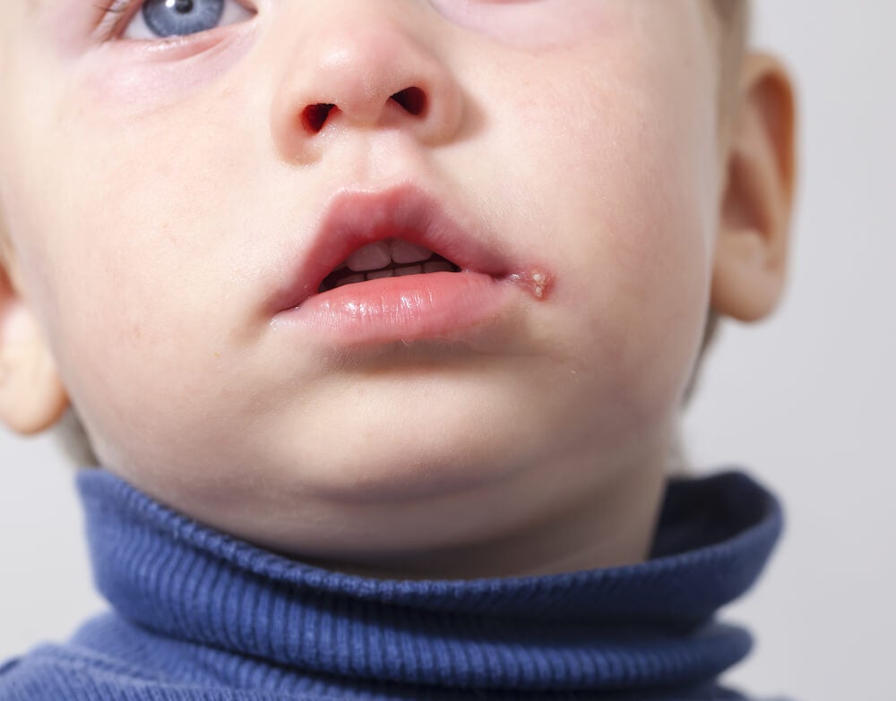 herpes bucal en niños