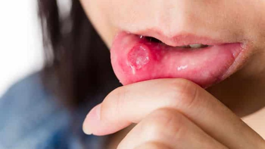 herpes parte interna de la boca