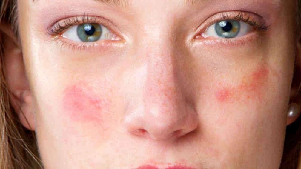 piel afectada por herpes