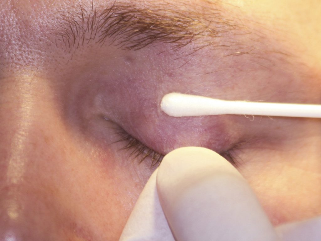 remedios para herpes en el ojo