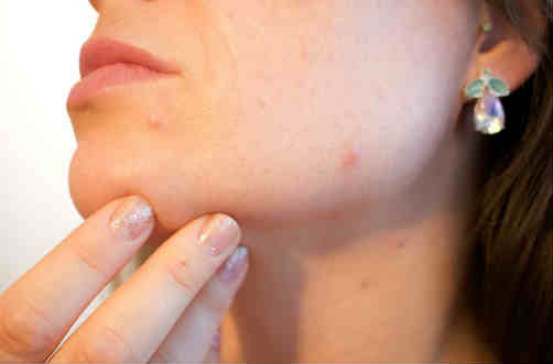 sintomas de herpes en la cara