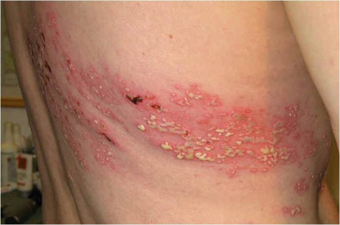 virus de herpes en la piel 
