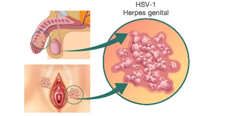 herpes genital en hombres y mujeres